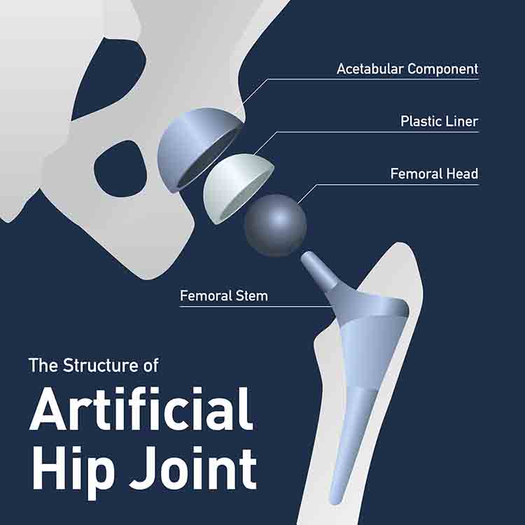 Stryker V40 defect hip implant