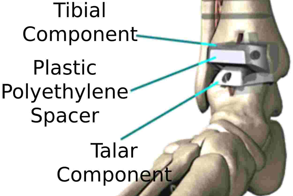 Defective Components of the Recalled Exactech Ankle