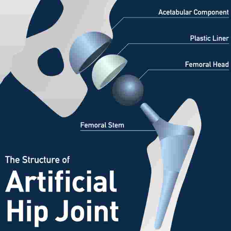 Defective Components of the Recalled Exactech Hip