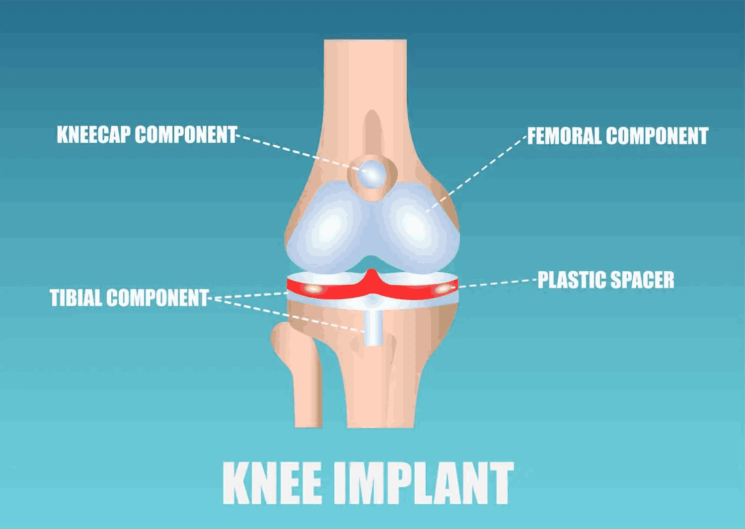 Recalled components of the Exactech Knee