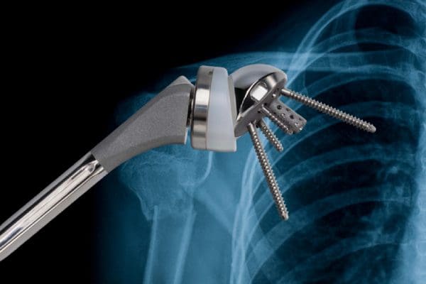 Exactech Equinoxe Shoulder Lawsuit