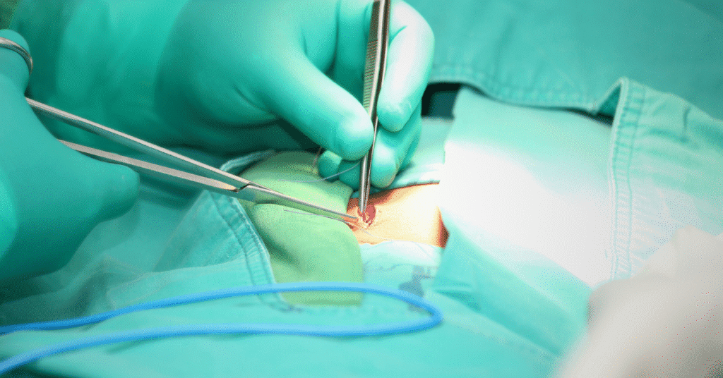 Gore-Tex hernia mesh device linked to severe complications and lawsuits