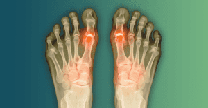 Close-up of a Cartiva synthetic cartilage toe implant next to a medical diagram of a foot joint.