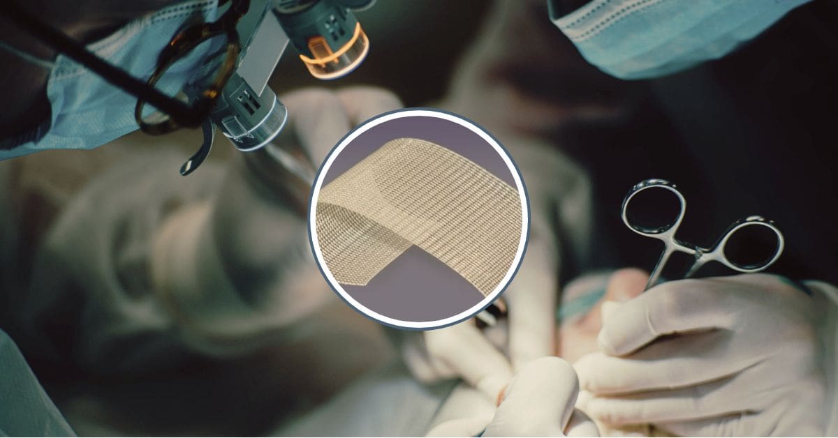 A close-up of a surgical hernia mesh implant and a medical folder, representing legal criteria for mesh lawsuits.