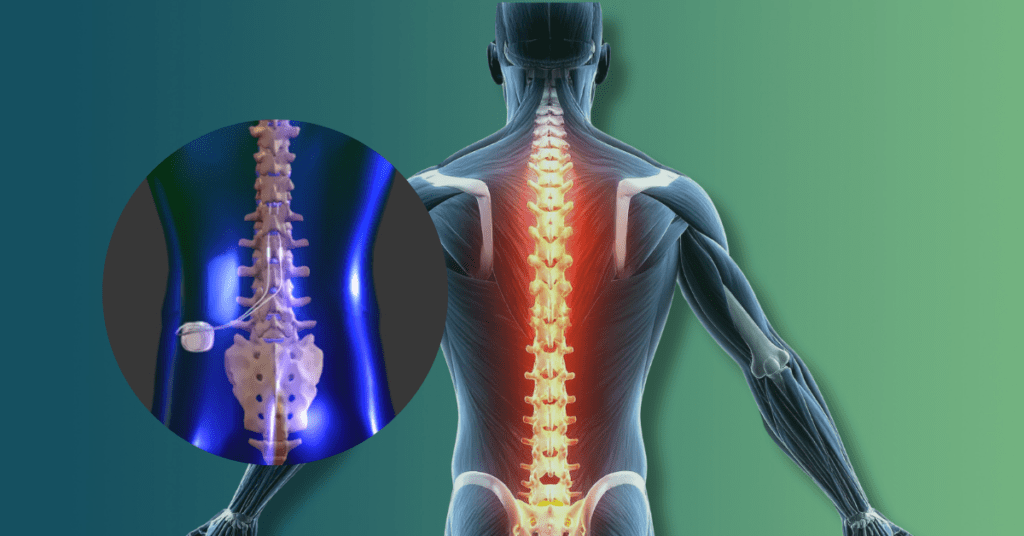 Medical illustration of a spinal cord stimulator lead implanted in the epidural space, highlighting potential areas of nerve damage.