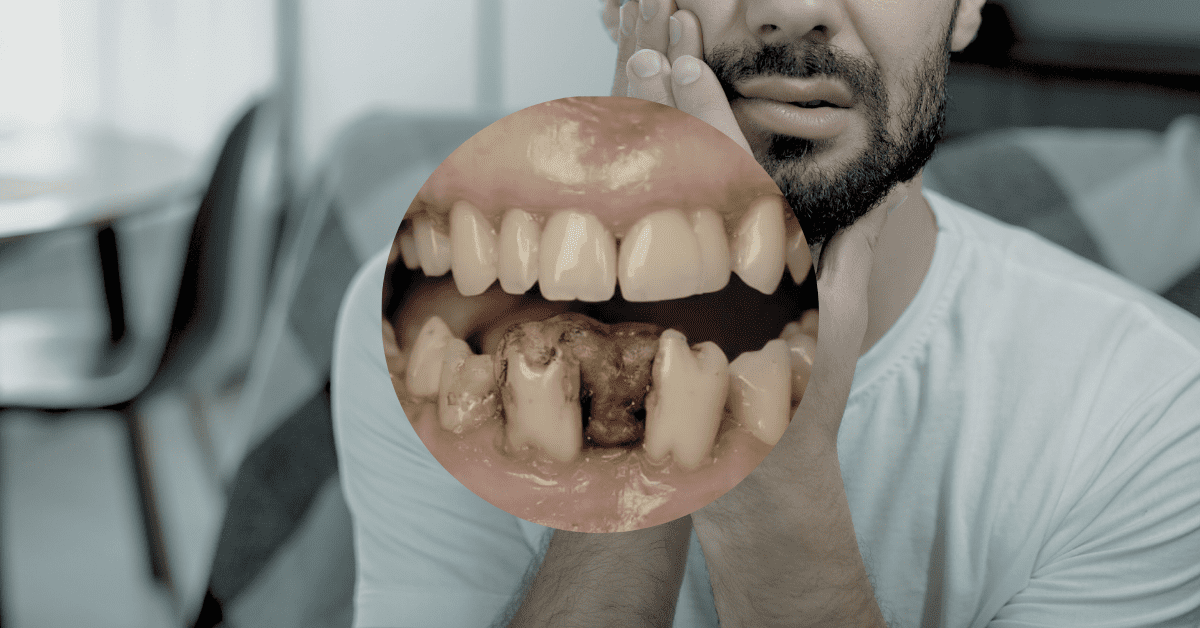 A dental X-ray showing severe tooth decay and extractions next to a Suboxone sublingual film strip.